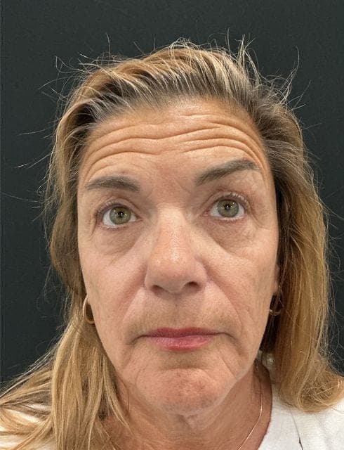Neuromodulators result, before treatment