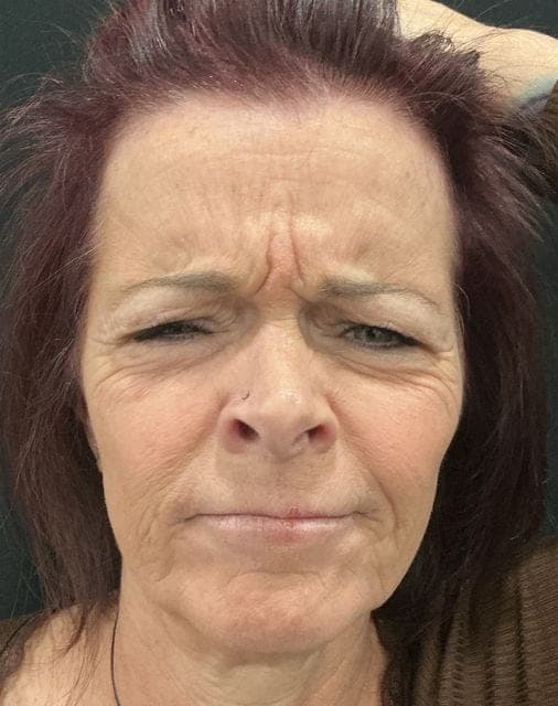 Neuromodulators result, before treatment