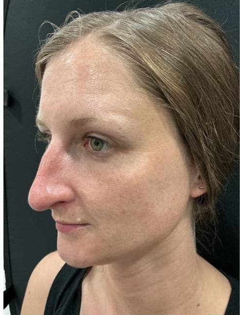 PhotoFacial IPL result, after treatment