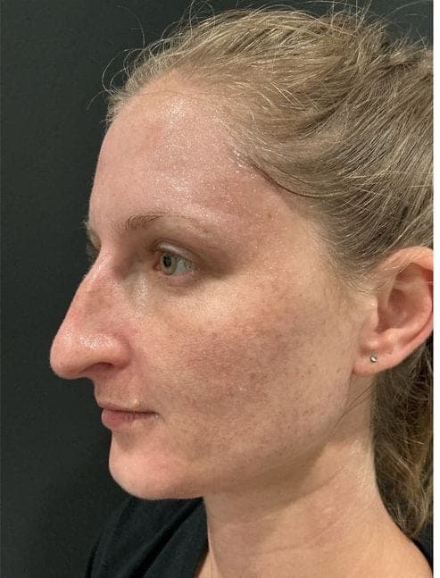 PhotoFacial IPL result, before treatment