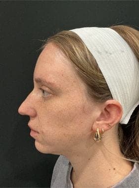 PhotoFacial IPL result, after treatment