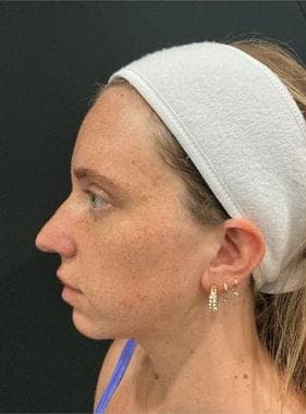 PhotoFacial IPL result, before treatment