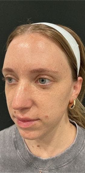 PhotoFacial IPL result, after treatment