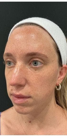 PhotoFacial IPL result, before treatment