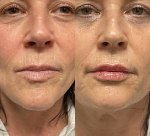 Dermal Filler before and after 1