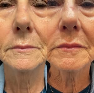 Dermal Filler before and after 2