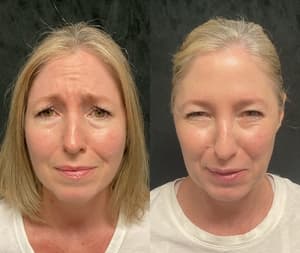 Neuromodulators (Tox) before and after 2