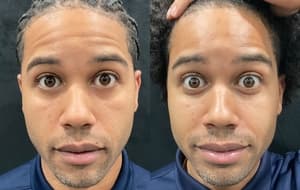 Neuromodulators (Tox) before and after 7