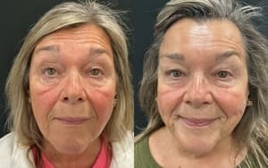 Neuromodulators (Tox) before and after 12