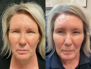 Neuromodulators (Tox) before and after 13