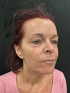 RF Microneedling before and after 1