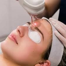 Patient wearing eye protection during a laser session