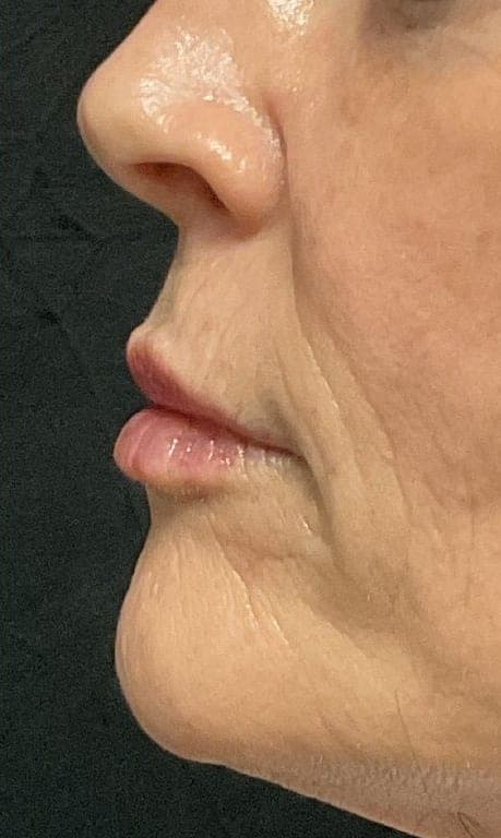 Dermal Filler result, after treatment