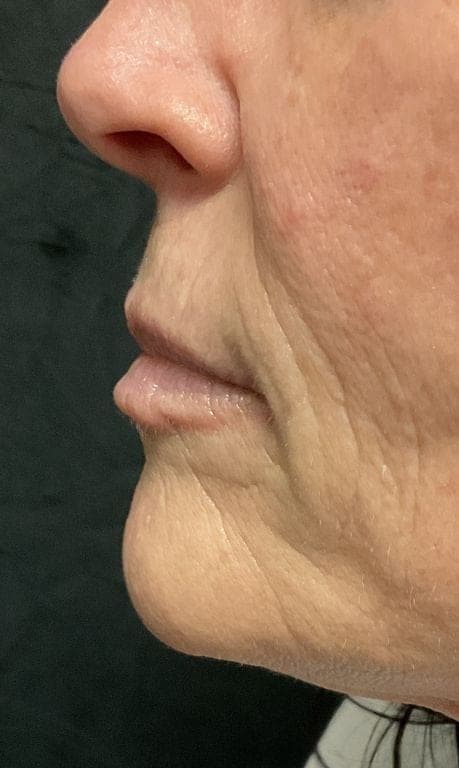 Dermal Filler result, before treatment