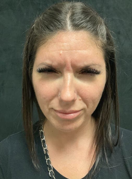 Neuromodulators result, before treatment