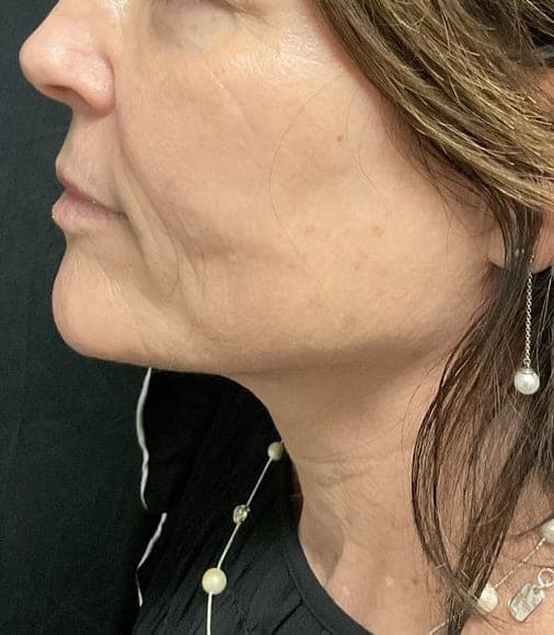 RF Microneedling result, after treatment
