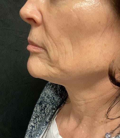 RF Microneedling result, before treatment