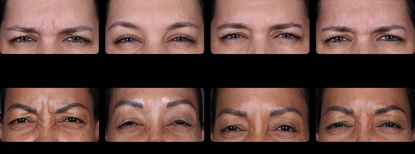 Daxxify before and after clinical result examples