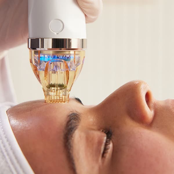 RF microneedling treatment near the eye
