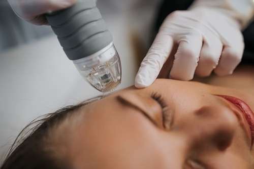 RF microneedling treatment in progress
